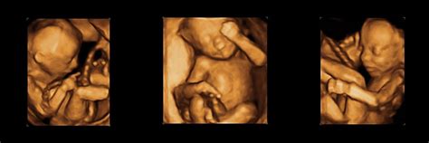 feto com 20 semanas fotos - criança com microcefalia